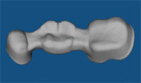 Tooth Bridge Design Digital tooth bridge creation