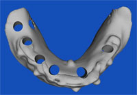 Dental Implant Planning Dental implant surgical planning