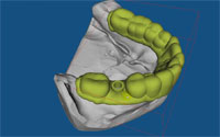 Drill Guide Design in VRMesh v7.5 Dental Implant - Drill Guide Design in VRMesh v7.5