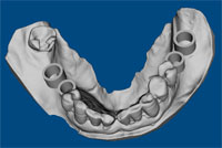 Drill Guide Design in Batch Processing Dental Drill Guide Design in VRMesh v7.6