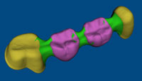 Dental Bridge STL Repair Dental Bridge STL Repair