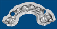 Drill Guide Design Dental Implant - Drill Guide Design